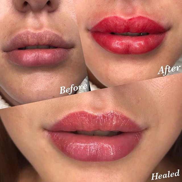 trattamento colortune 7