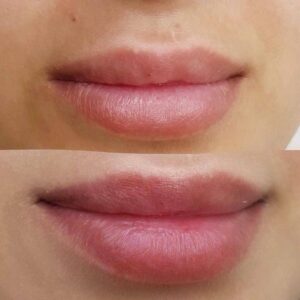 trattamento colortune 6 trattamento colortune 6