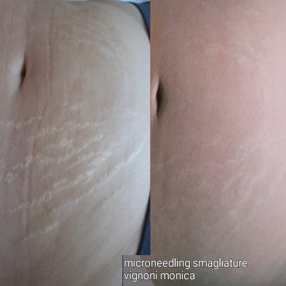 FOTO-TRATTAMENTI-SU-SMAGLIATURE