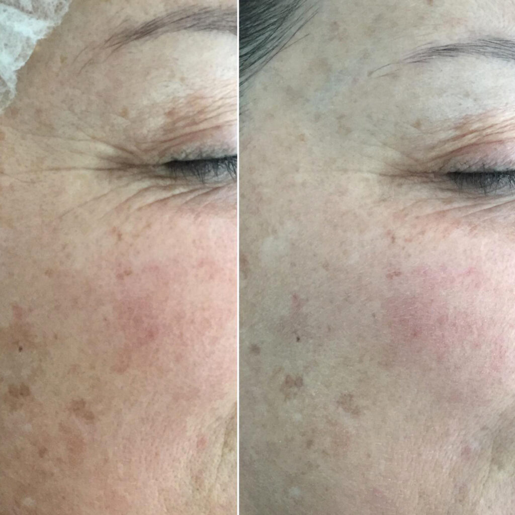 trattamento 3_inPixio 4