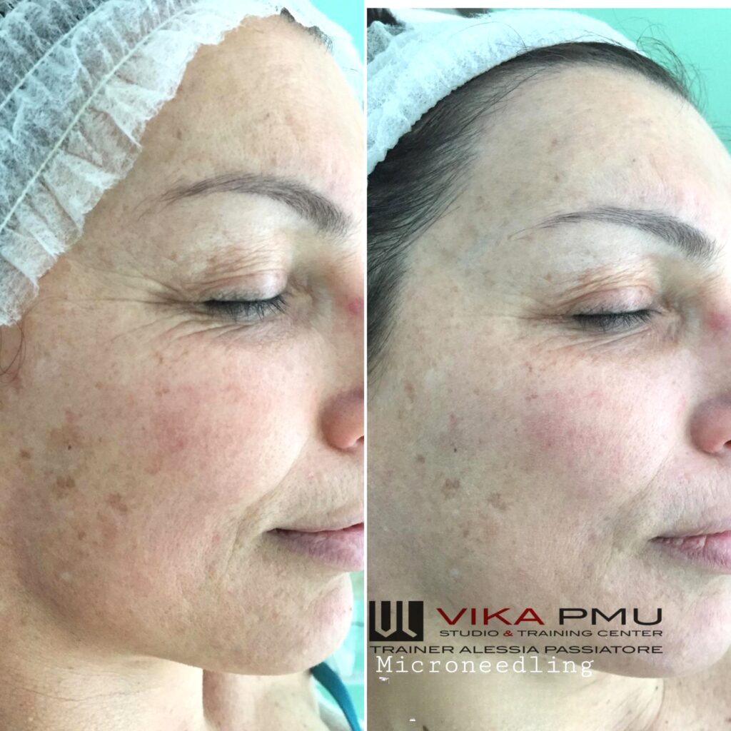 trattamento 4_inPixio